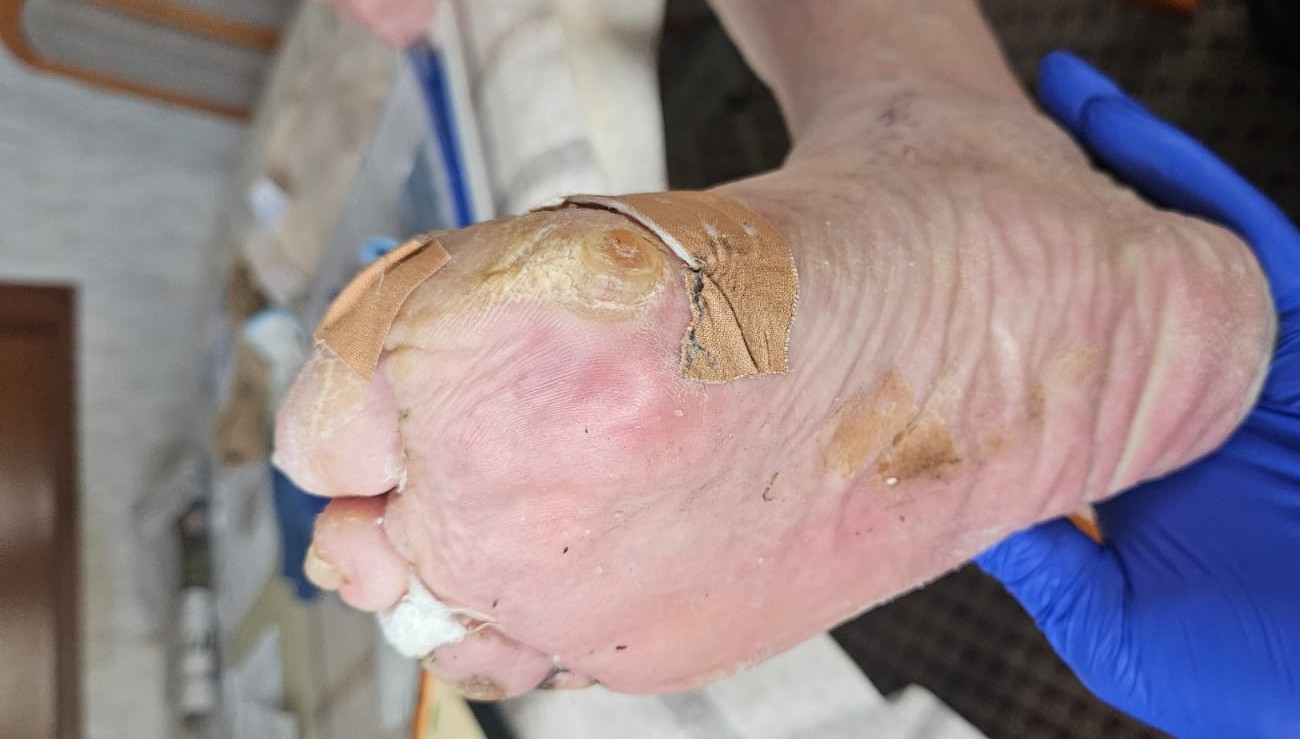 Fußpflege Villingen-Schwenningen bei Druckstellen im Alter