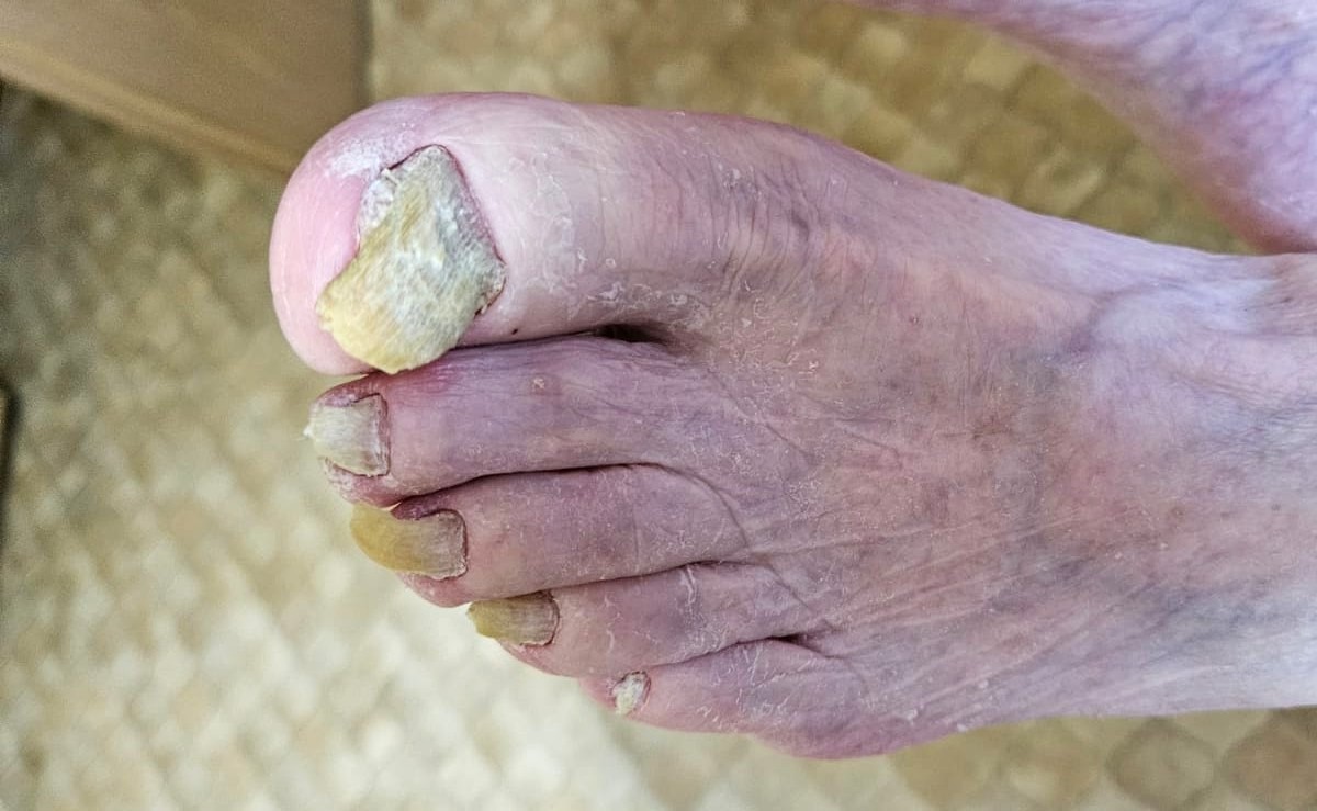 Fußpflege Villingen-Schwenningen bei stark verdickten Holznägeln (Onychogrypose)