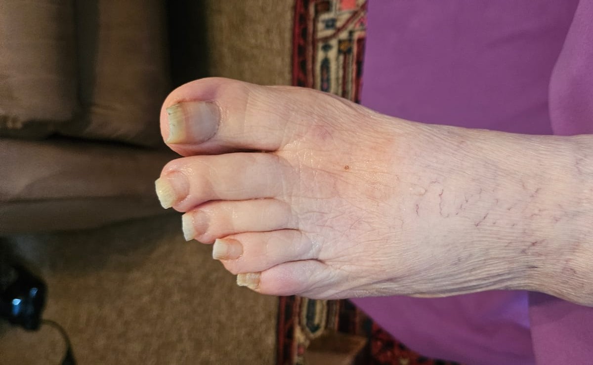 Mobile medizinische Fußpflege bei verdickten Zehennägeln