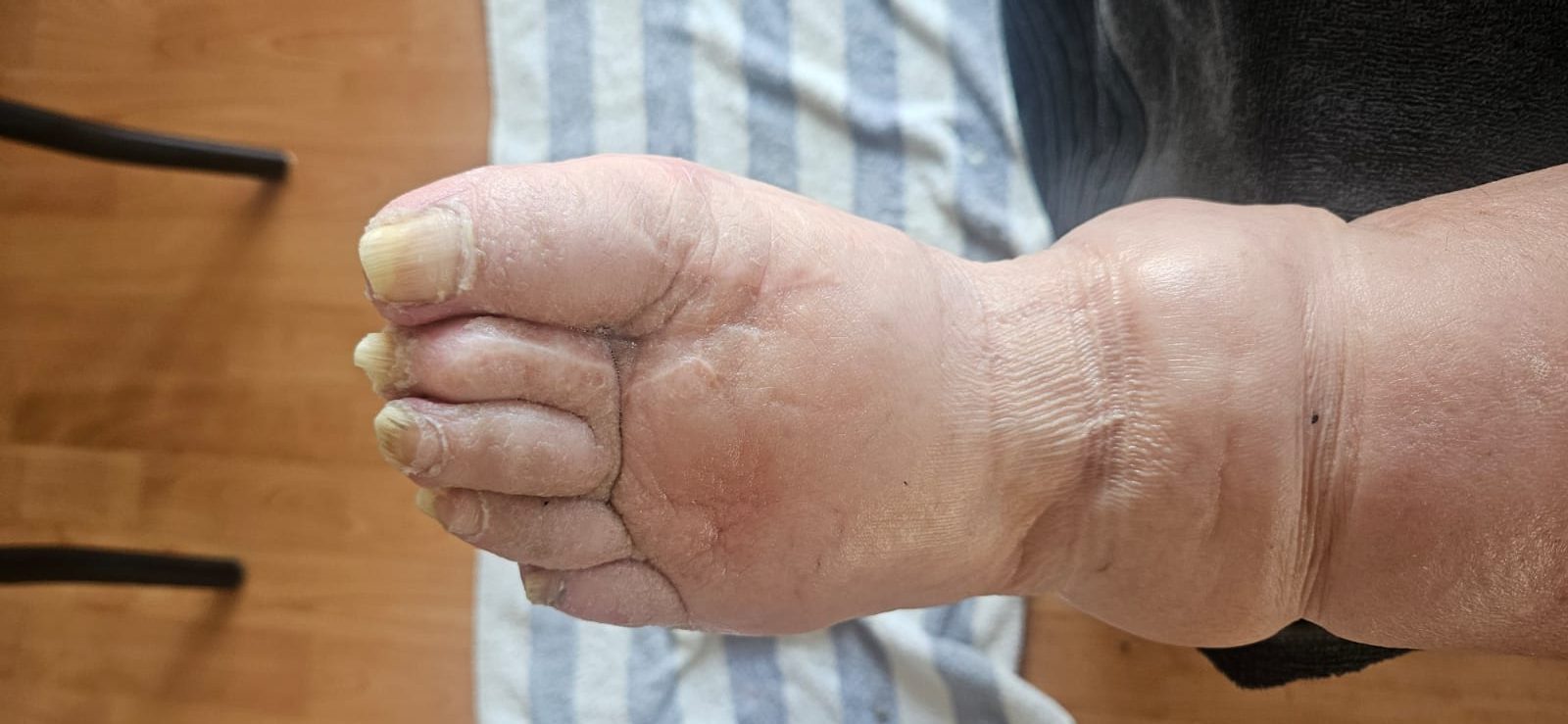 Fußpflege Villingen-Schwenningen Senioren verdickte Nägel