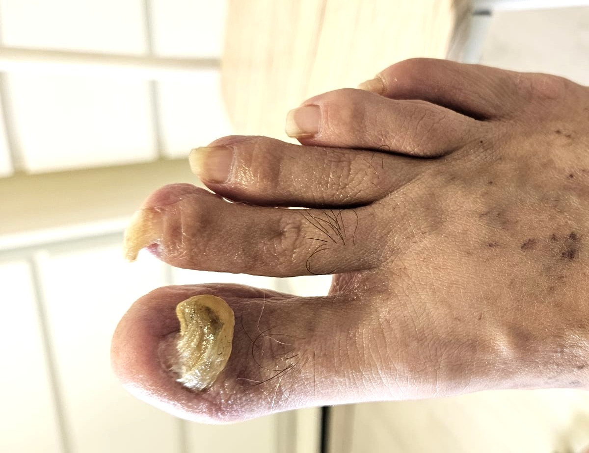 Mobile Fußpflege Villingen bei stark gekrümmten Zehennägeln