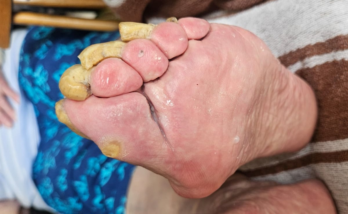 Mobile medizinische Fußpflege in Schwenningen bei stark verdickten, gekrümmten Zehennägeln