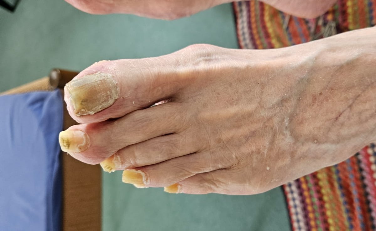 Mobile medizinische Fußpflege in Villingen-Schwenningen bei stark verhärteten Holznägeln