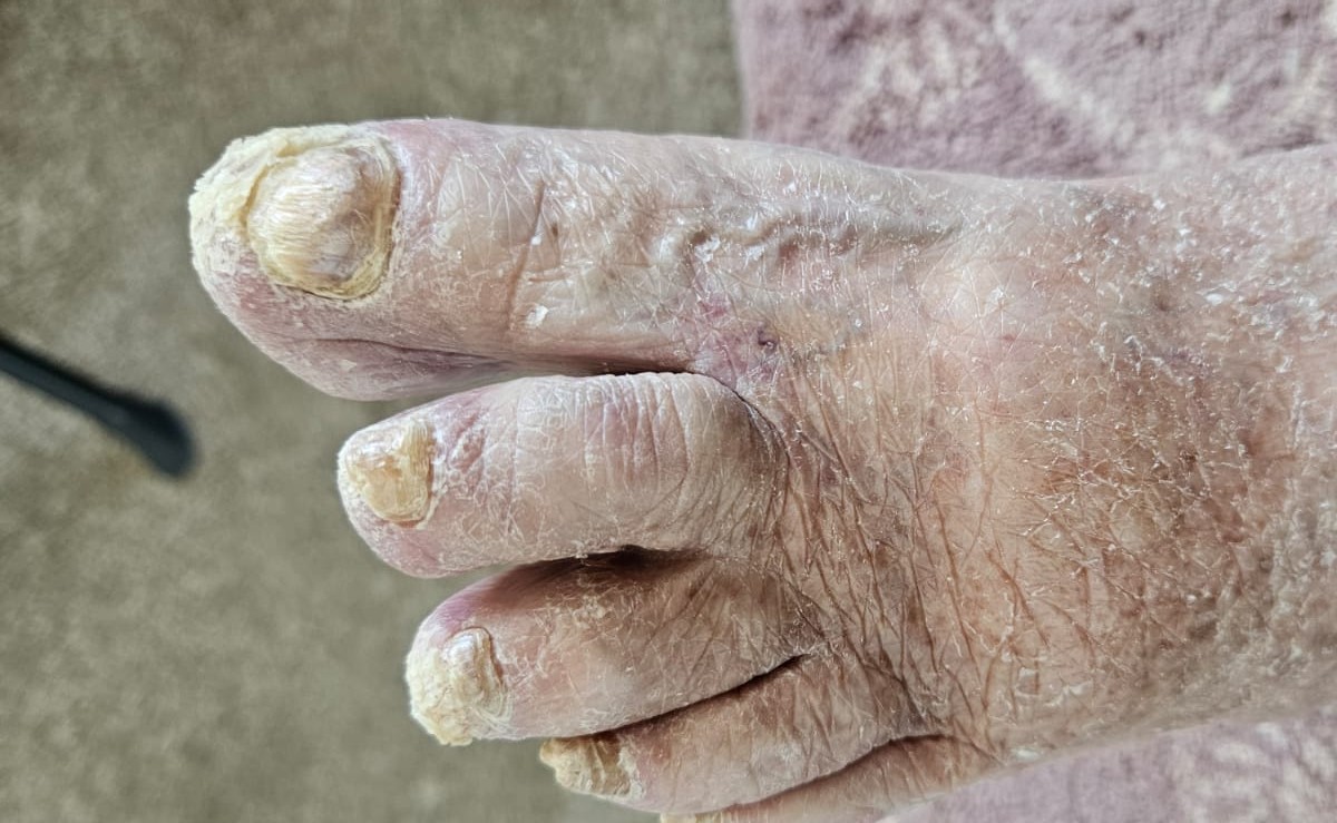 Mobile medizinische Fußpflege bei verdickten Nägeln und schmerzenden Druckstellen in Villingen