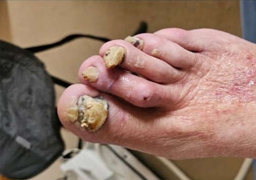 Mobile medizinische Fußpflege Villingen-Schwenningen mykotisch wirkende Pilznaegel