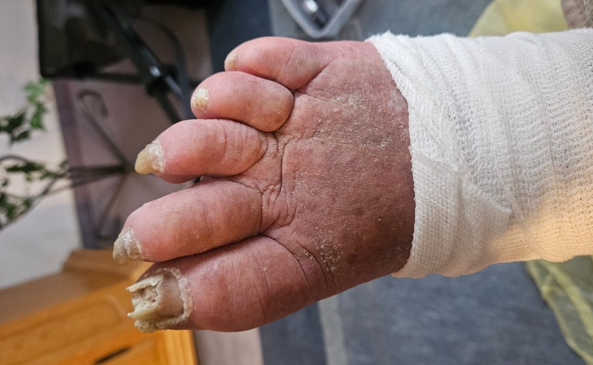 Mobile medizinische Fußpflege Villingen-Schwenningen bei veränderten Nägeln